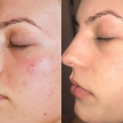 Laser Treatment for Skin Clinic Patna